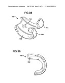 FEMORAL PROSTHETIC IMPLANT diagram and image