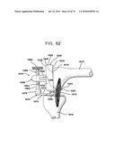 FEMORAL PROSTHETIC IMPLANT diagram and image