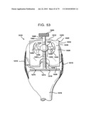 FEMORAL PROSTHETIC IMPLANT diagram and image