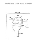 FEMORAL PROSTHETIC IMPLANT diagram and image