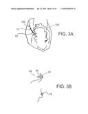 SYSTEMS AND METHODS FOR CLOSING AN APERTURE IN A BODILY TISSUE diagram and image