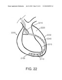 SYSTEMS AND METHODS FOR CLOSING AN APERTURE IN A BODILY TISSUE diagram and image