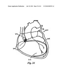 SYSTEMS AND METHODS FOR CLOSING AN APERTURE IN A BODILY TISSUE diagram and image