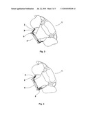 BRIDGING DEVICE FOR LAMINOPLASTY AND APPLICATIONS THEREOF diagram and image