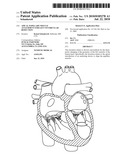 Apical Papillary Msucle Attachment for Left Ventricular Reduction diagram and image