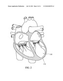 Apical Papillary Msucle Attachment for Left Ventricular Reduction diagram and image