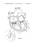 Apical Papillary Msucle Attachment for Left Ventricular Reduction diagram and image