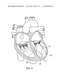 Apical Papillary Msucle Attachment for Left Ventricular Reduction diagram and image