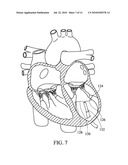 Apical Papillary Msucle Attachment for Left Ventricular Reduction diagram and image