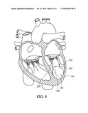 Apical Papillary Msucle Attachment for Left Ventricular Reduction diagram and image