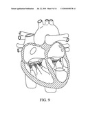 Apical Papillary Msucle Attachment for Left Ventricular Reduction diagram and image