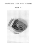 Apical Papillary Msucle Attachment for Left Ventricular Reduction diagram and image