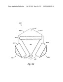 TILED TRANSITION BRACKETING diagram and image