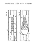 Endotracheal tube cleaning apparatus diagram and image