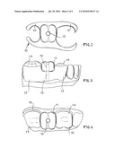 TOOTH-IMPLANT METHOD AND APPLIANCE diagram and image