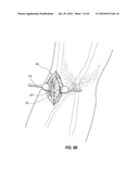 SUBCUTANEOUS VASCULAR ACCESS PORTS AND RELATED SYSTEMS AND METHODS diagram and image