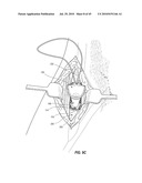 SUBCUTANEOUS VASCULAR ACCESS PORTS AND RELATED SYSTEMS AND METHODS diagram and image