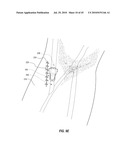 SUBCUTANEOUS VASCULAR ACCESS PORTS AND RELATED SYSTEMS AND METHODS diagram and image