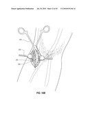 SUBCUTANEOUS VASCULAR ACCESS PORTS AND RELATED SYSTEMS AND METHODS diagram and image