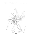 SUBCUTANEOUS VASCULAR ACCESS PORTS AND RELATED SYSTEMS AND METHODS diagram and image