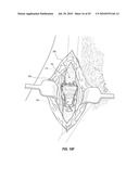 SUBCUTANEOUS VASCULAR ACCESS PORTS AND RELATED SYSTEMS AND METHODS diagram and image