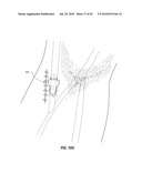 SUBCUTANEOUS VASCULAR ACCESS PORTS AND RELATED SYSTEMS AND METHODS diagram and image