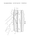 SUBCUTANEOUS VASCULAR ACCESS PORTS AND RELATED SYSTEMS AND METHODS diagram and image