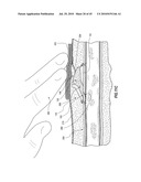 SUBCUTANEOUS VASCULAR ACCESS PORTS AND RELATED SYSTEMS AND METHODS diagram and image