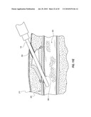 SUBCUTANEOUS VASCULAR ACCESS PORTS AND RELATED SYSTEMS AND METHODS diagram and image