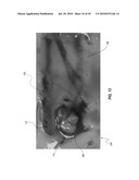 SUBCUTANEOUS VASCULAR ACCESS PORTS AND RELATED SYSTEMS AND METHODS diagram and image