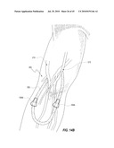 SUBCUTANEOUS VASCULAR ACCESS PORTS AND RELATED SYSTEMS AND METHODS diagram and image