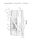 SUBCUTANEOUS VASCULAR ACCESS PORTS AND RELATED SYSTEMS AND METHODS diagram and image