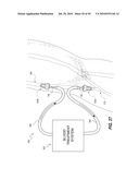 SUBCUTANEOUS VASCULAR ACCESS PORTS AND RELATED SYSTEMS AND METHODS diagram and image