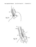 SURGICAL INSTRUMENTS AND TECHNIQUES FOR TREATING GASTRO-ESOPHAGEAL REFLUX DISEASE diagram and image