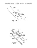 SURGICAL INSTRUMENTS AND TECHNIQUES FOR TREATING GASTRO-ESOPHAGEAL REFLUX DISEASE diagram and image