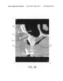 Surgical Guide for use during sinus elevation surgery utilizing the caldwell-luc osteotomy diagram and image