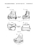 SURGICAL TEMPLATES diagram and image