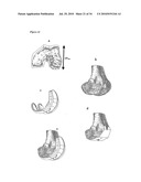 SURGICAL TEMPLATES diagram and image