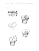 SURGICAL TEMPLATES diagram and image