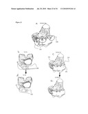 SURGICAL TEMPLATES diagram and image