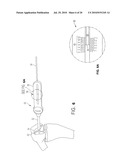 Trochlear Resurfacing System and Method diagram and image