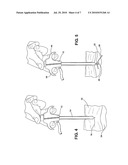 VERESS NEEDLE WITH ILLUMINATED GUIDANCE AND SUTURING CAPABILITY diagram and image