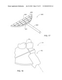 METHODS, APPARATUS AND SYSTEM FOR USE IN DENTAL PROCEDURES diagram and image