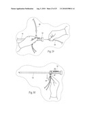 Systems and methods for optimizing and maintaining visualization of a surgical field during the use of surgical scopes diagram and image