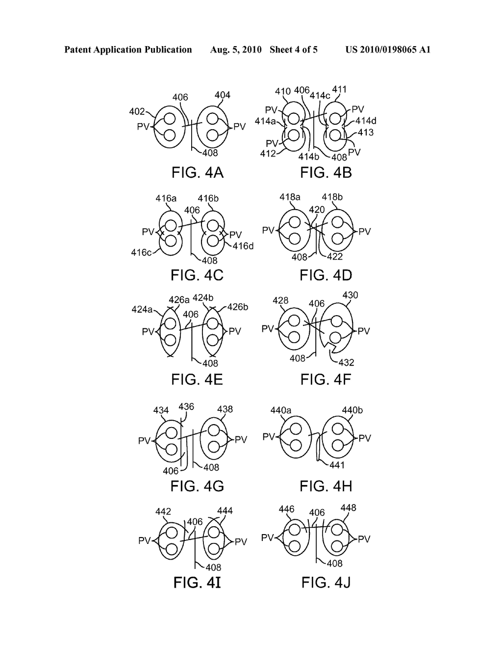 SYSTEM AND METHOD FOR ULTRASONICALLY SENSING AND ABLATING TISSUE - diagram, schematic, and image 05