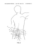 METHODS AND APPARATUS FOR DECUBITUS ULCER PREVENTION AND TREATMENT diagram and image