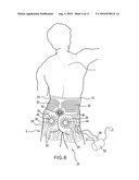 METHODS AND APPARATUS FOR DECUBITUS ULCER PREVENTION AND TREATMENT diagram and image