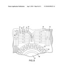 METHODS AND APPARATUS FOR DECUBITUS ULCER PREVENTION AND TREATMENT diagram and image