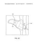 SYSTEMS AND METHODS FOR ANESTHETIZING EAR TISSUE diagram and image