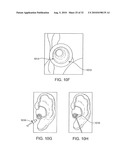 SYSTEMS AND METHODS FOR ANESTHETIZING EAR TISSUE diagram and image